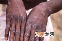 猴痘病毒已发生人际传播，世卫发布猴痘疫情暴发预警