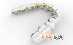 普通的牙套一般多少钱