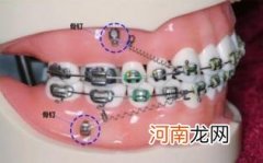 补完牙需要套牙套吗